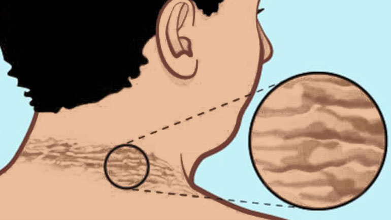 how to get rid of neck darkness